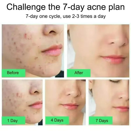 Salicylic Acne Repair Cream