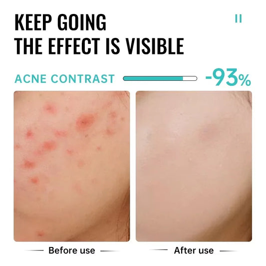 Anti Scar Face Treatment
